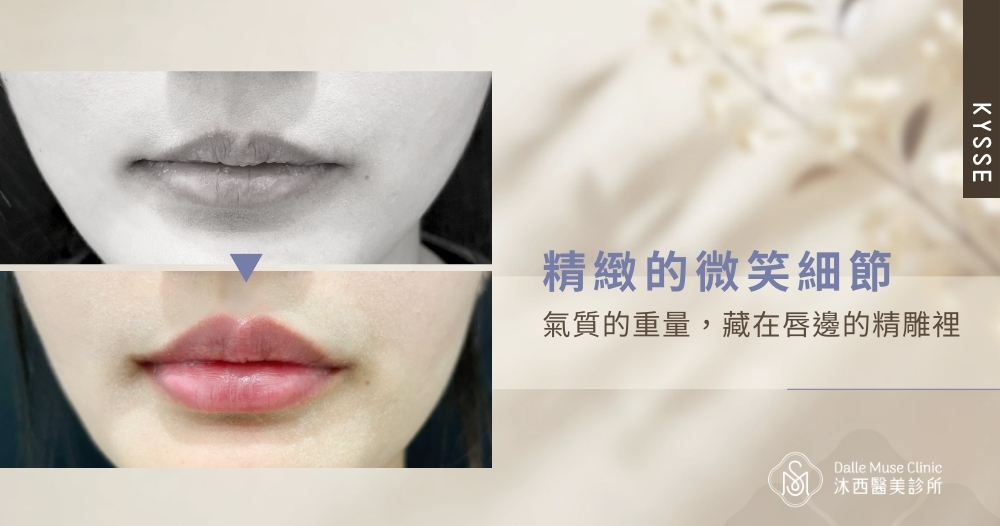 氣質的重量,藏在唇邊的精雕裡-『Kysse唇部玻尿酸』精緻的微笑細節