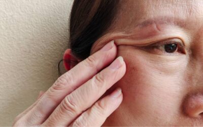 無雙電波 Density 能拯救眼周下垂？大安區沐西醫美用精準技術讓鬆弛問題得到改善